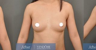 療程效果因人而異，上圖為B罩杯產後女性在做完自體脂肪隆乳之後​手術後兩個月、手術後七個月成效